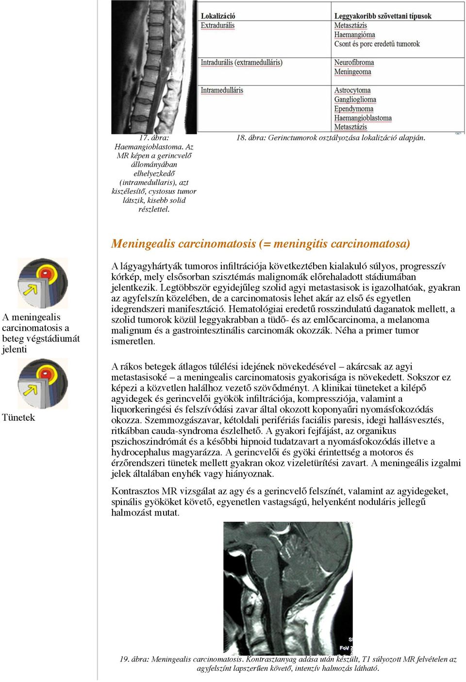 Meningealis carcinomatosis (= meningitis carcinomatosa) A meningealis carcinomatosis a beteg végstádiumát jelenti Tünetek A lágyagyhártyák tumoros infiltrációja következtében kialakuló súlyos,