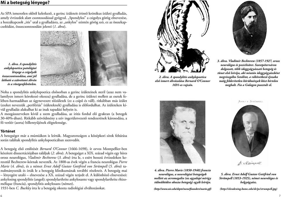 . 1. ábra. A spondylitis ankylopoetica patológiai lényege a csigolyák összecsontosodása, ami jól látható a szövettani ábrán és a röntgenfelvételen.