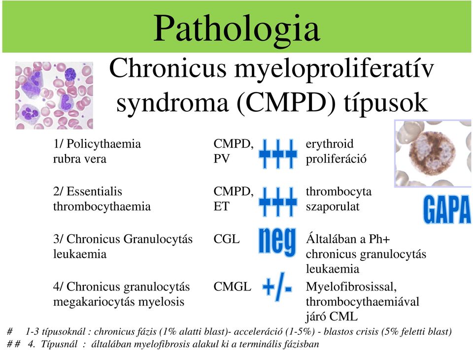 CMGL Általában a Ph+ chronicus granulocytás leukaemia Myelofibrosissal, thrombocythaemiával járó CML # 1-3 típusoknál : chronicus fázis (1%