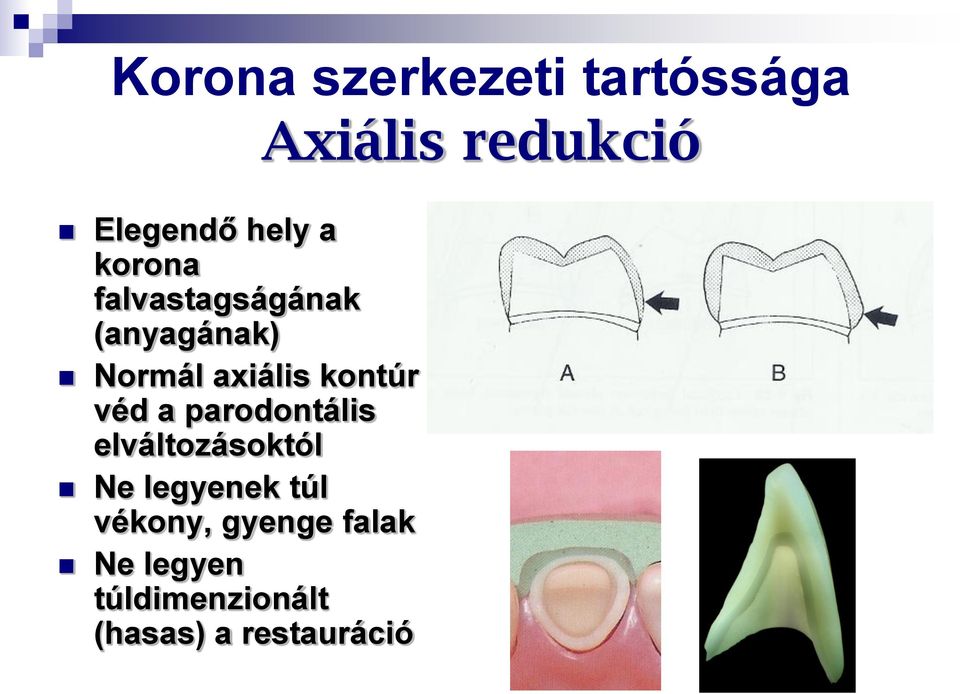 parodontális elváltozásoktól Ne legyenek túl vékony, gyenge