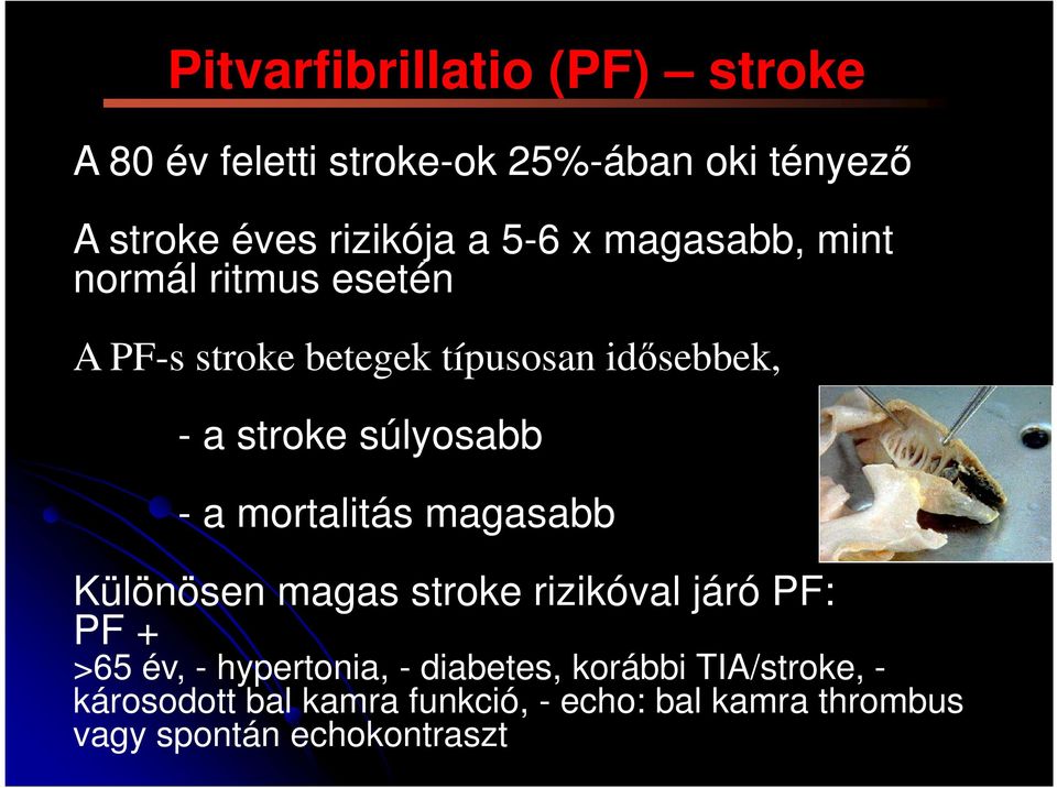 súlyosabb - a mortalitás magasabb Különösen magas stroke rizikóval járó PF: PF + >65 év, - hypertonia, -