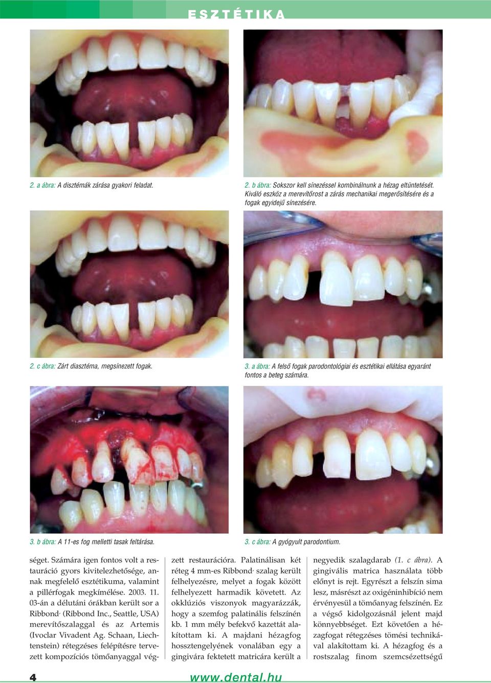 a ábra: A felsô fogak parodontológiai és esztétikai ellátása egyaránt fontos a beteg számára. 3. b ábra: A 11-es fog melletti tasak feltárása. 3. c ábra: A gyógyult parodontium. 4 séget.