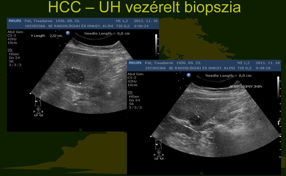 biopszia