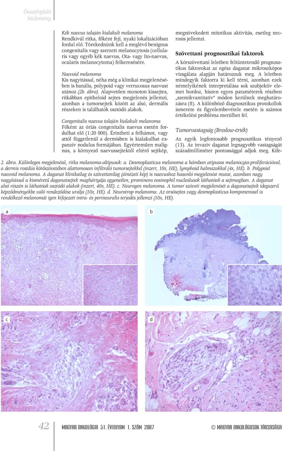 Naevoid melanoma Kis nagyítással, néha még a klinikai megjelenésében is banális, polypoid vagy verrucosus naevust utánoz (2b. ábra).