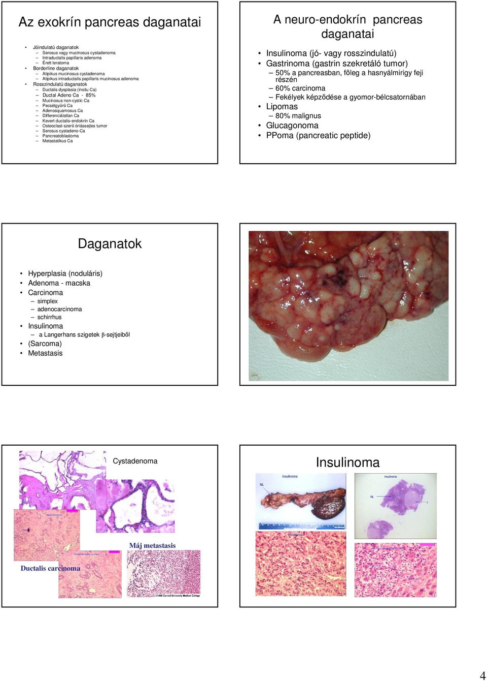 Kevert ductalis-endokrín Ca Osteoclast-szerő óriássejtes tumor Serosus cystadeno-ca Pancreatoblastoma Metastatikus Ca A neuro-endokrín pancreas daganatai Insulinoma (jó- vagy rosszindulatú)