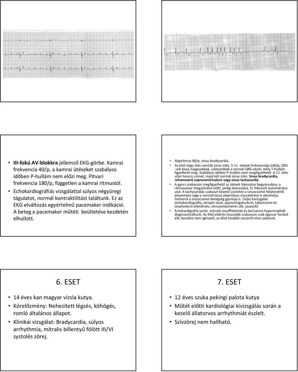 A beteg a pacemaker műtéti beültetése kezdetén elhullott. Alapritmus 80/p, sinus bradycardia. Az elsőnégy ütés normál sinus ütés. 5-11.