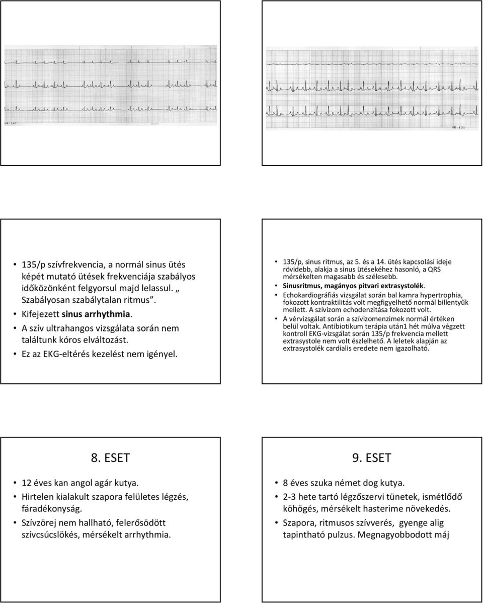 ütés kapcsolási ideje rövidebb, alakja a sinus ütésekéhez hasonló, a QRS mérsékelten magasabb és szélesebb. Sinusritmus, magányos pitvari extrasystolék.