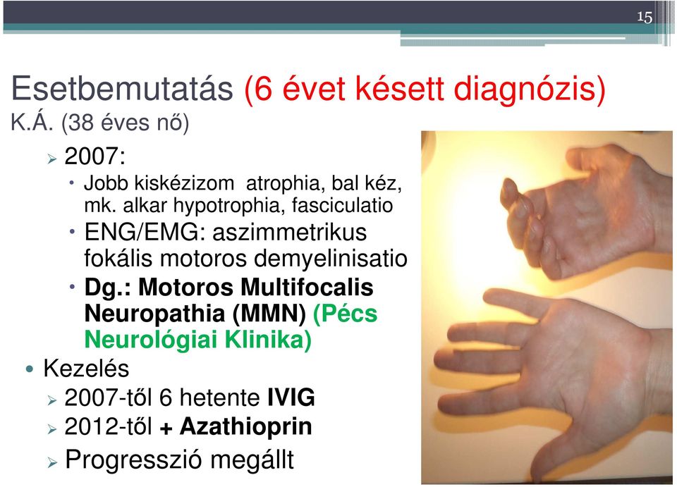 alkar hypotrophia, fasciculatio ENG/EMG: aszimmetrikus fokális motoros