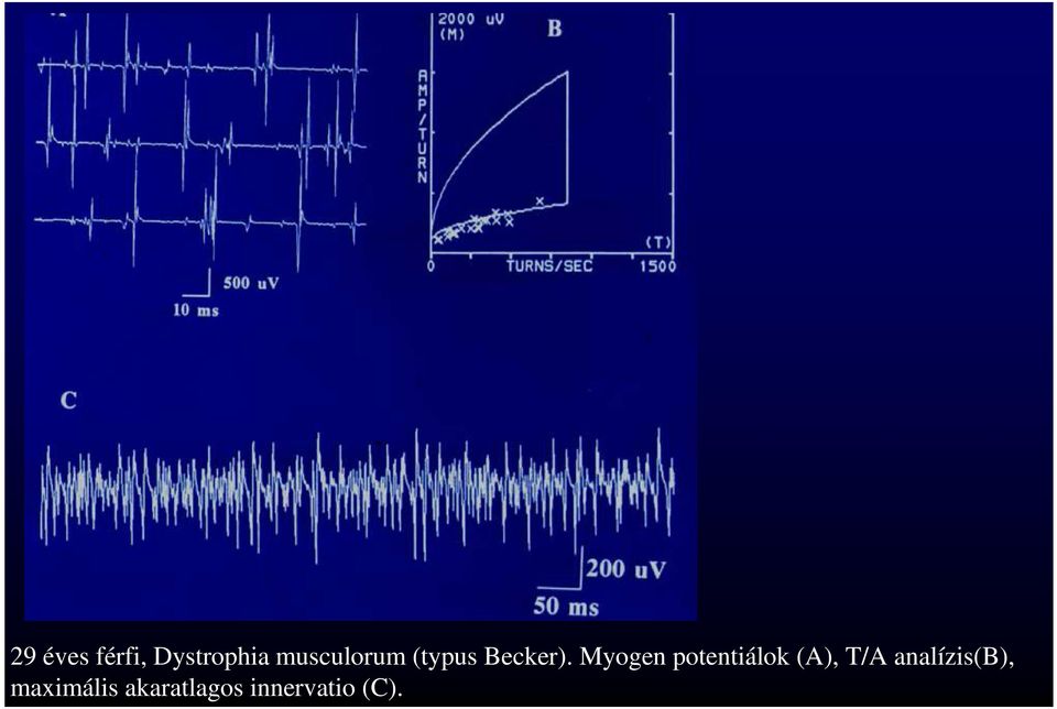 Myogen potentiálok (A), T/A