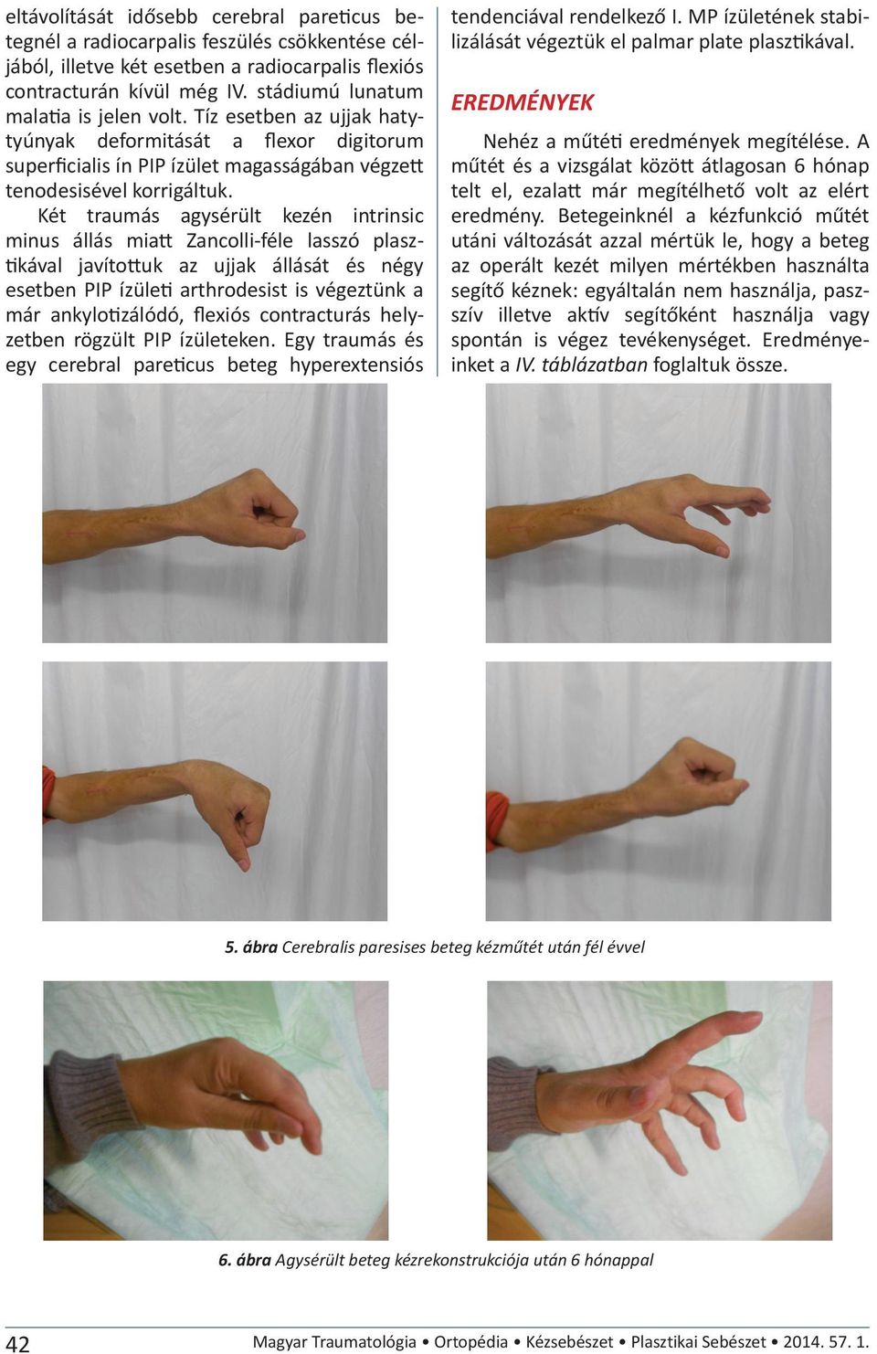 Két traumás agysérült kezén intrinsic minus állás miatt Zancolli-féle lasszó plasztikával javítottuk az ujjak állását és négy esetben PIP ízületi arthrodesist is végeztünk a már ankylotizálódó,