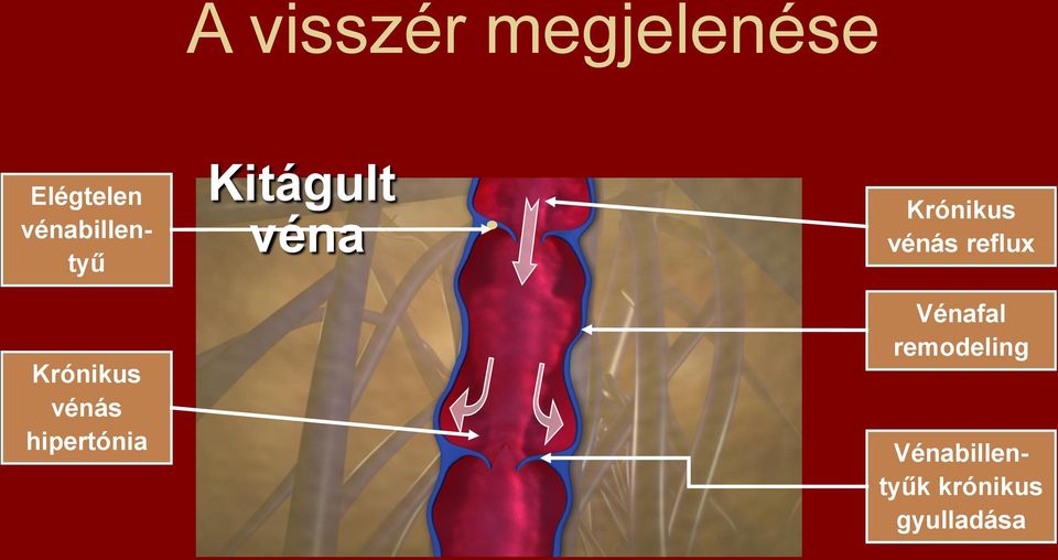 hipertónia Vénafal remodeling Elégtelen