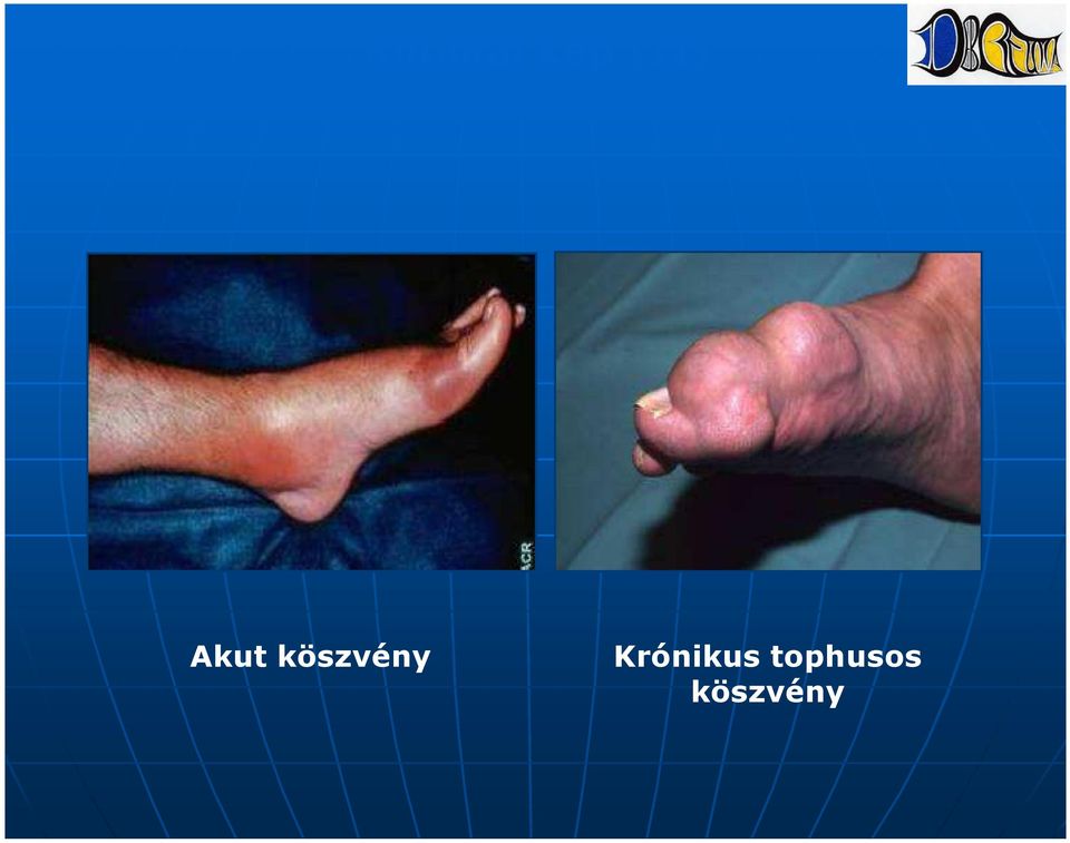 köszvény