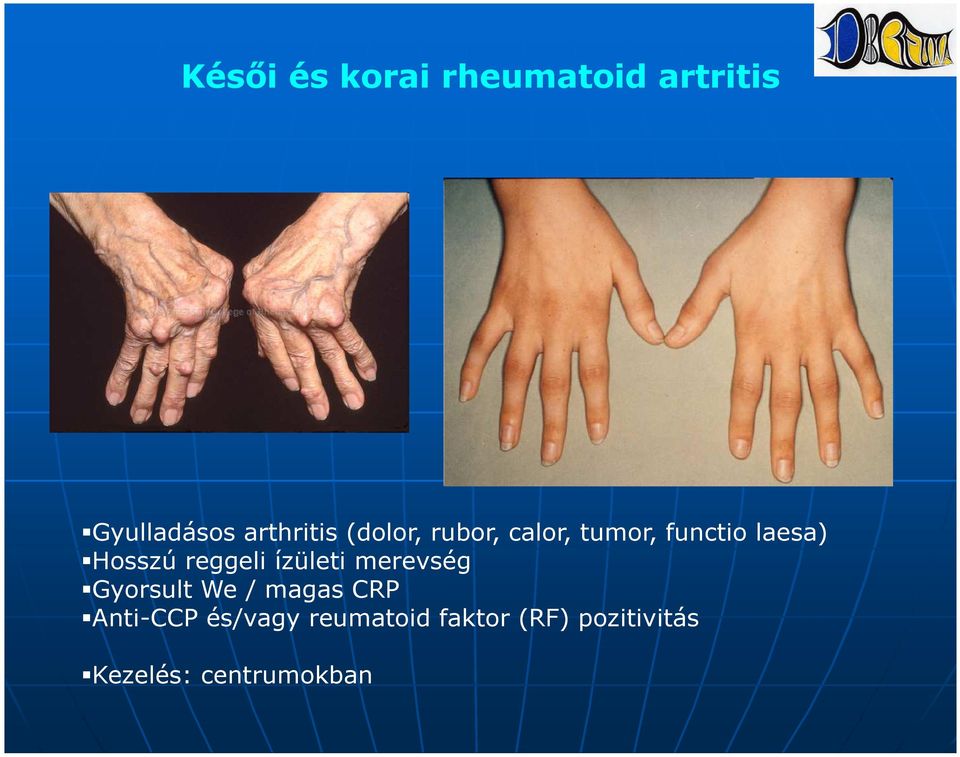 reggeli ízületi merevség Gyorsult We / magas CRP Anti-CCP