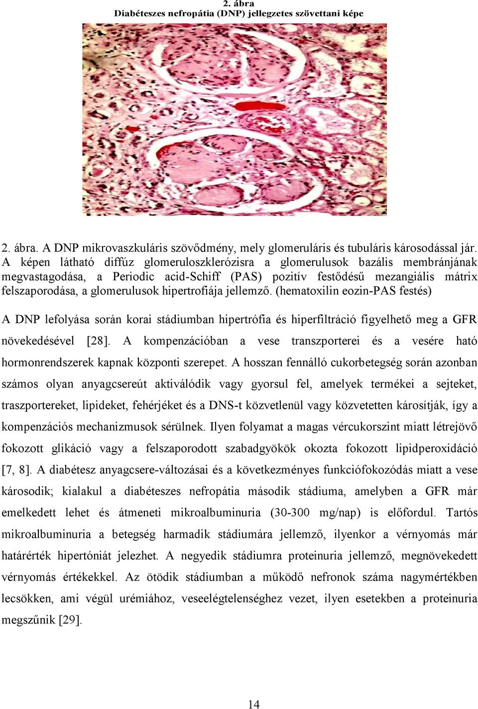 hipertrofiája jellemző. (hematoxilin eozin-pas festés) A DNP lefolyása során korai stádiumban hipertrófia és hiperfiltráció figyelhető meg a GFR növekedésével [28].