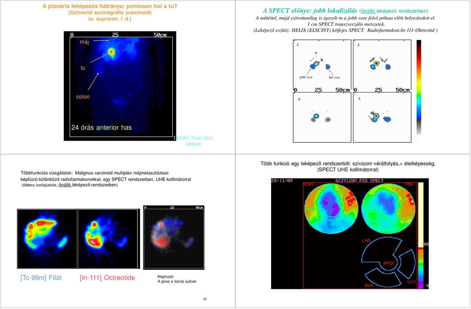 1 cm SPECT transzverzális metszetek. (Leképező eszköz: HELIX (ELSCINT) kétfejes SPECT. Radiofarmakon:In-111-Oktreotid ) 1. 2. tu tu jobb vese bal vese colon 4. 3. 24 órás anterior has DEOEC Nukl.Med.