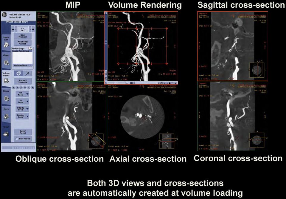 Coronal cross-section Both 3D views and