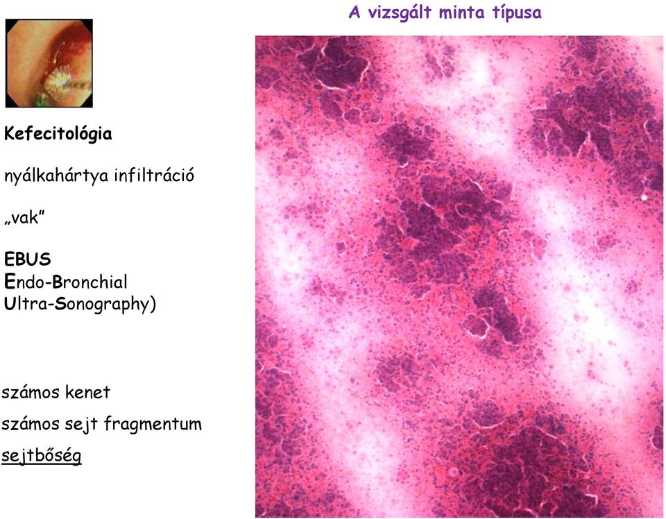 Endo-Bronchial Ultra-Sonography)