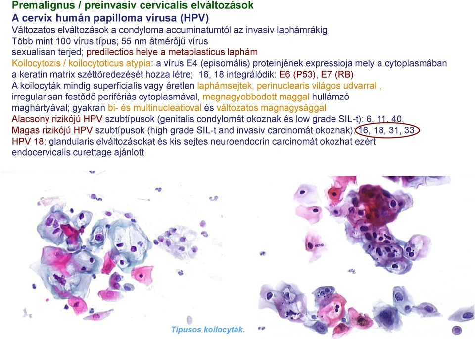 matrix széttöredezését hozza létre; 16, 18 integrálódik: E6 (P53), E7 (RB) A koilocyták mindig superficialis vagy éretlen laphámsejtek, perinuclearis világos udvarral, irregularisan festődő