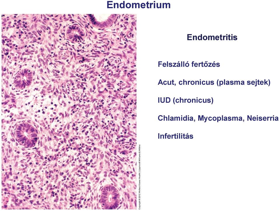 sejtek) IUD (chronicus) Chlamidia,