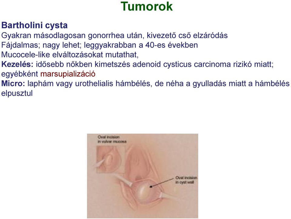 Kezelés: idősebb nőkben kimetszés adenoid cysticus carcinoma rizikó miatt; egyébként