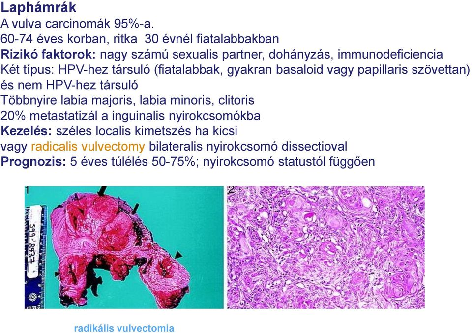 HPV-hez társuló (fiatalabbak, gyakran basaloid vagy papillaris szövettan) és nem HPV-hez társuló Többnyire labia majoris, labia minoris,