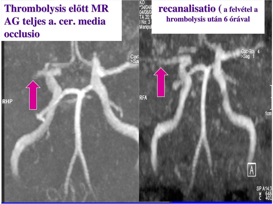 media occlusio recanalisatio (