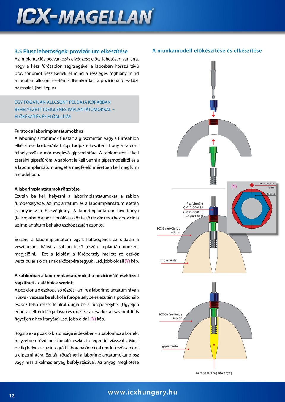 kép A) A munkamodell előkészítése és elkészítése Egy fogatlan állcsont példája korábban behelyezett ideiglenes implantátumokkal előkészítés és előállítás Furatok a laborimplantátumokhoz A