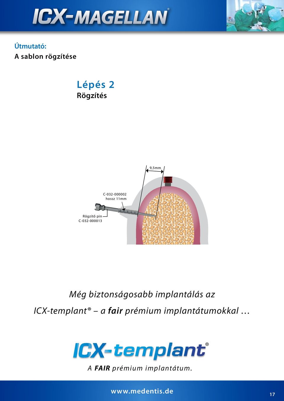 biztonságosabb implantálás az ICX-templant a fair prémium