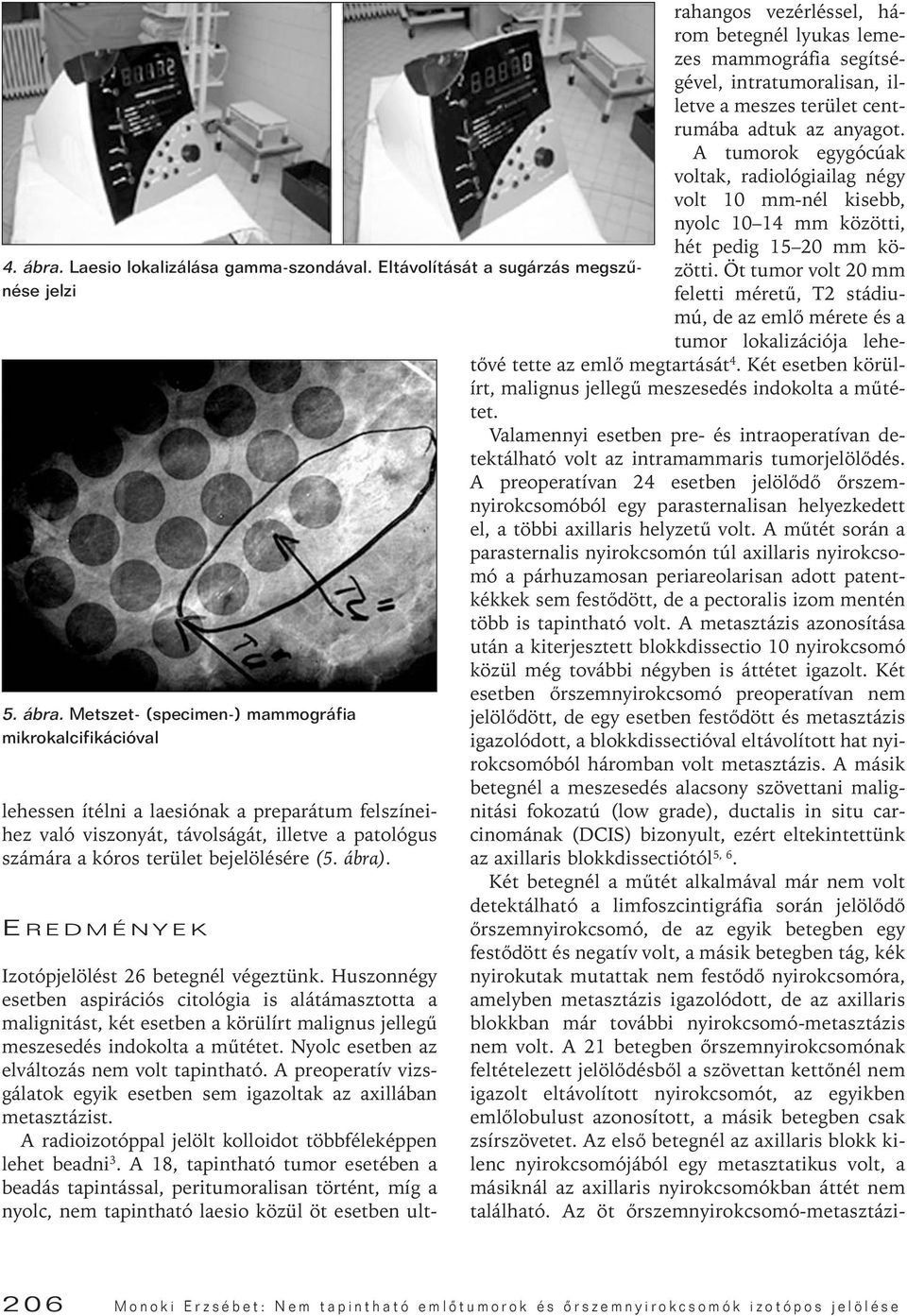 Metszet- (specimen-) mammográfia mikrokalcifikációval lehessen ítélni a laesiónak a preparátum felszíneihez való viszonyát, távolságát, illetve a patológus számára a kóros terület bejelölésére (5.