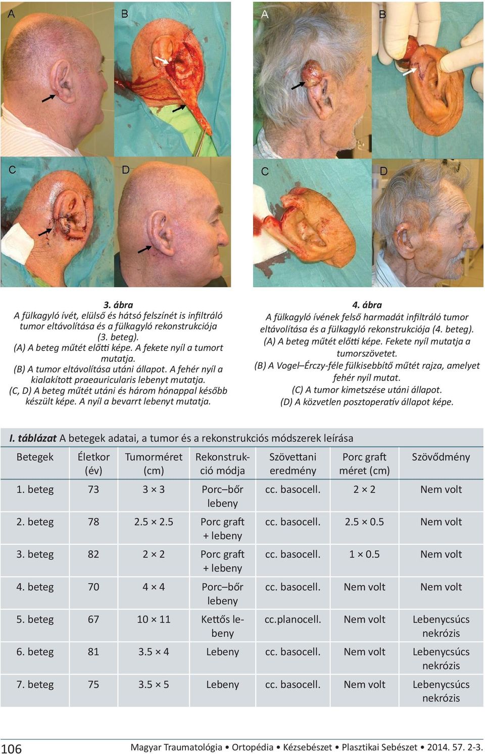 A nyíl a bevarrt lebenyt 4. ábra A fülkagyló ívének felső harmadát infiltráló tumor eltávolítása és a fülkagyló rekonstrukciója (4. beteg). (A) A beteg műtét előtti képe.