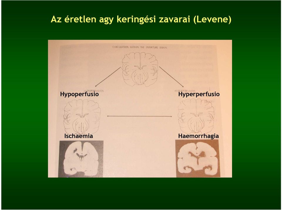 (Levene) Hypoperfusio