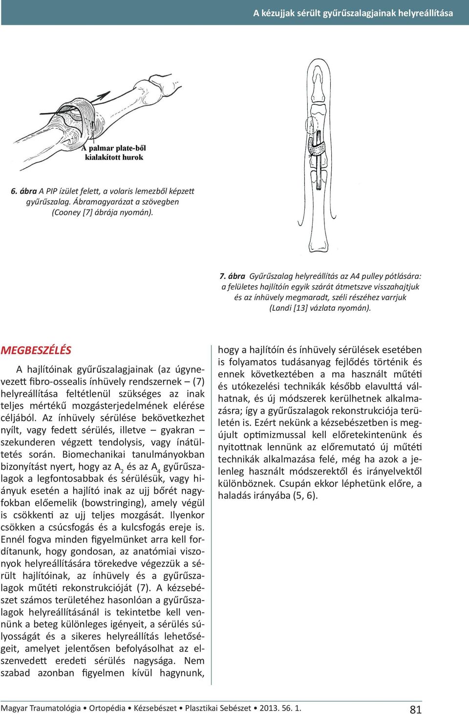 MEGBESZÉLÉS A hajlítóinak gyűrűszalagjainak (az úgyneveze fibro-ossealis ínhüvely rendszernek (7) helyreállítása feltétlenül szükséges az inak teljes mértékű mozgásterjedelmének elérése céljából.
