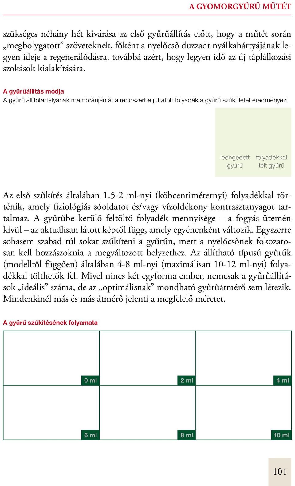 A gyűrűállítás módja A gyűrű állítótartályának membránján át a rendszerbe juttatott folyadék a gyűrű szűkületét eredményezi leengedett gyűrű folyadékkal telt gyűrű Az első szűkítés általában 1.