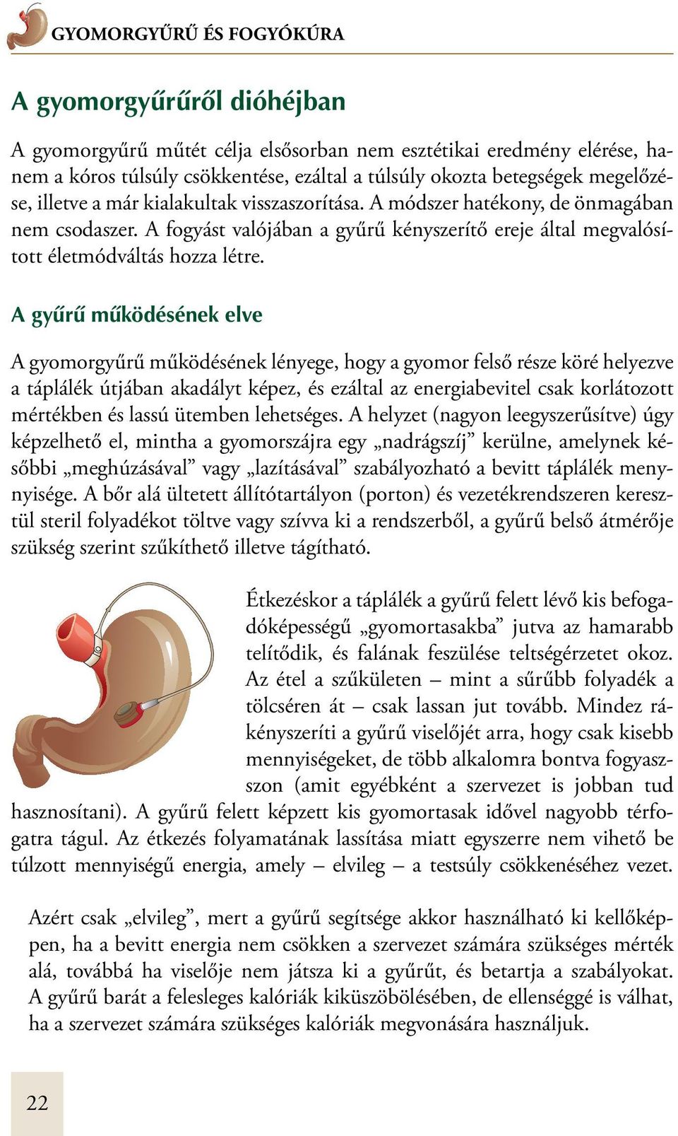 A gyûrû mûködésének elve A gyomorgyűrű működésének lényege, hogy a gyomor felső része köré helyezve a táplálék útjában akadályt képez, és ezáltal az energiabevitel csak korlátozott mértékben és lassú