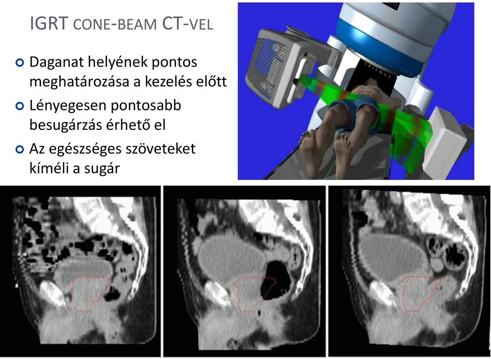 Lényegesen pontosabb besugárzás érhető