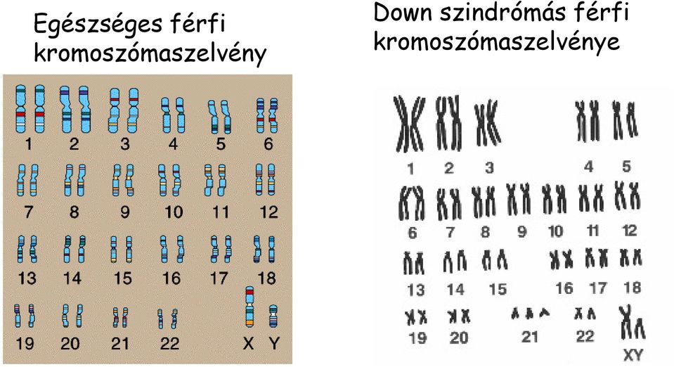 e Down szindrómás