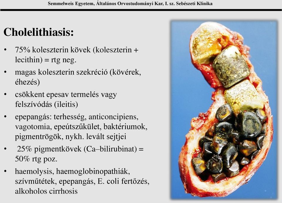 epepangás: terhesség, anticoncipiens, vagotomia, epeútszűkület, baktériumok, pigmentrögök, nykh.