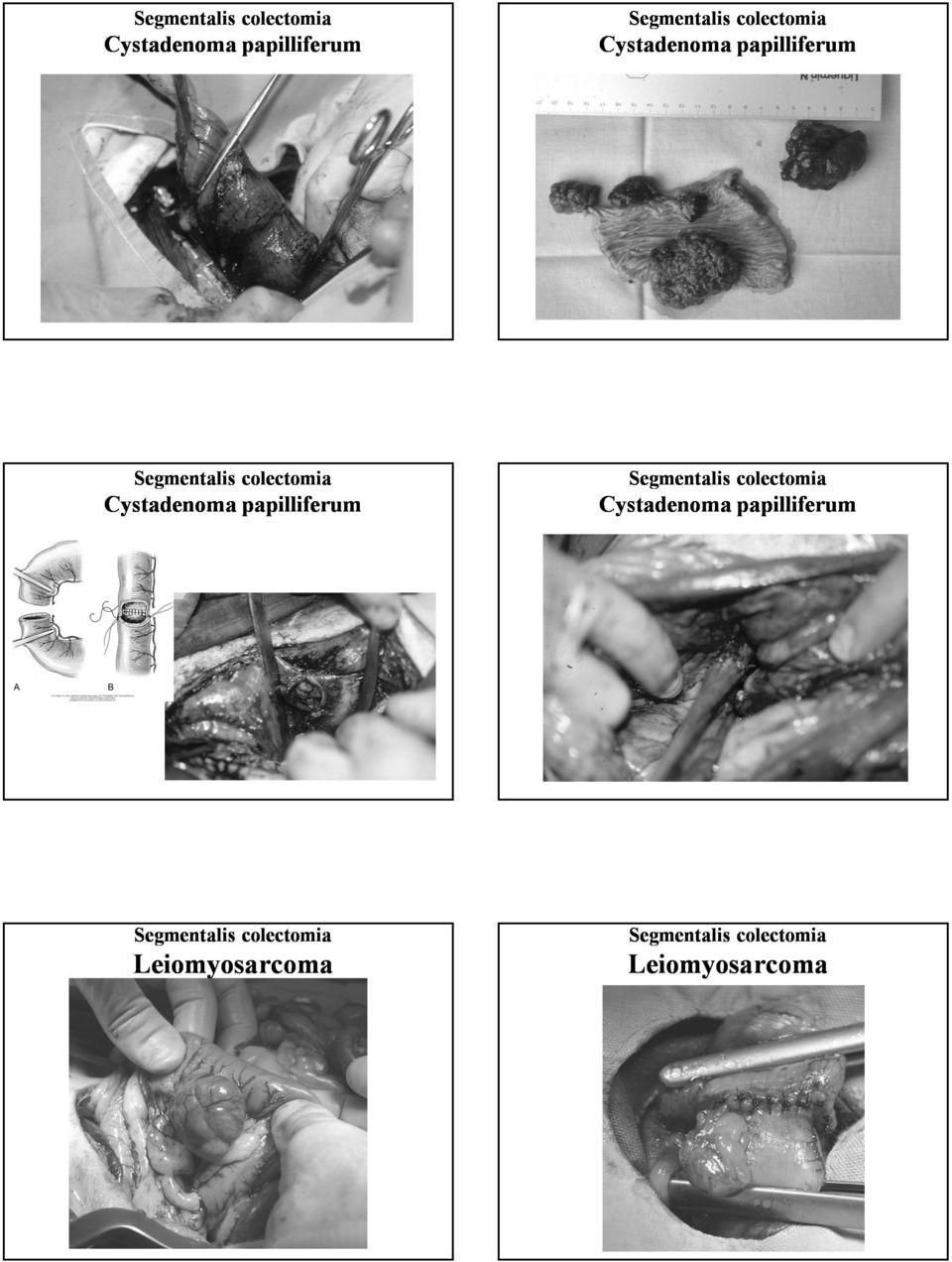 papilliferum Segmentalis colectomia Segmentalis colectomia