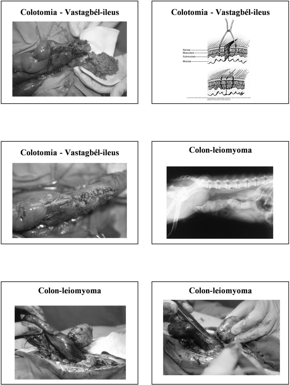 Colon--leiomyoma Colon