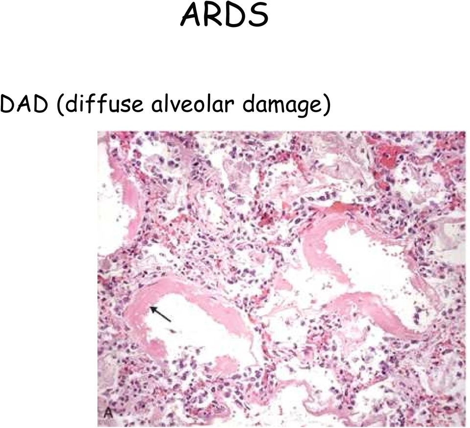 alveolar