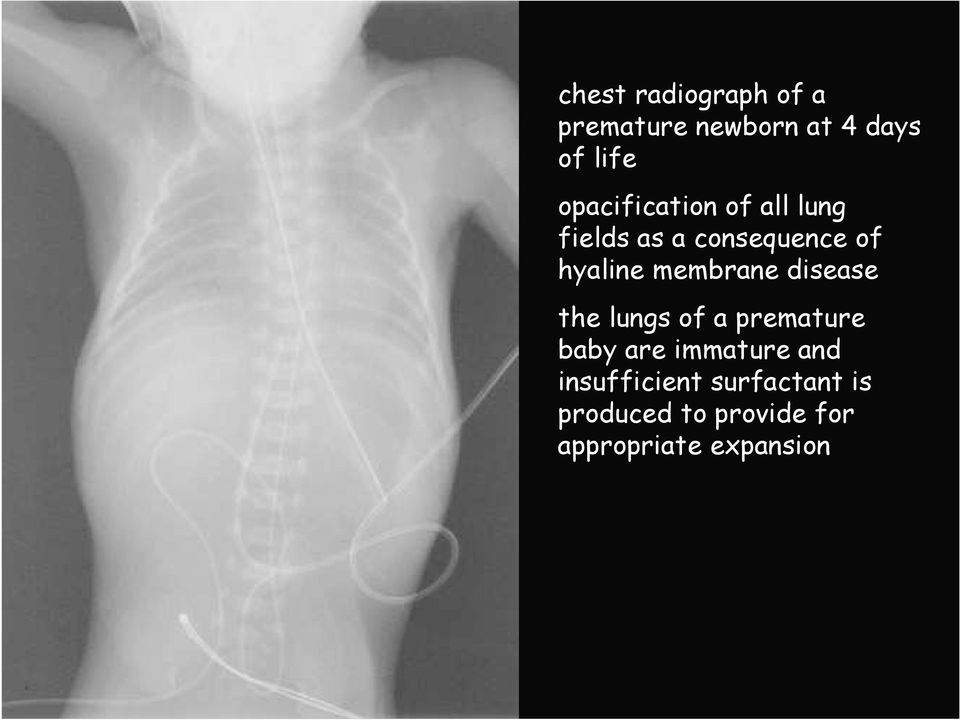 membrane disease the lungs of a premature baby are immature and