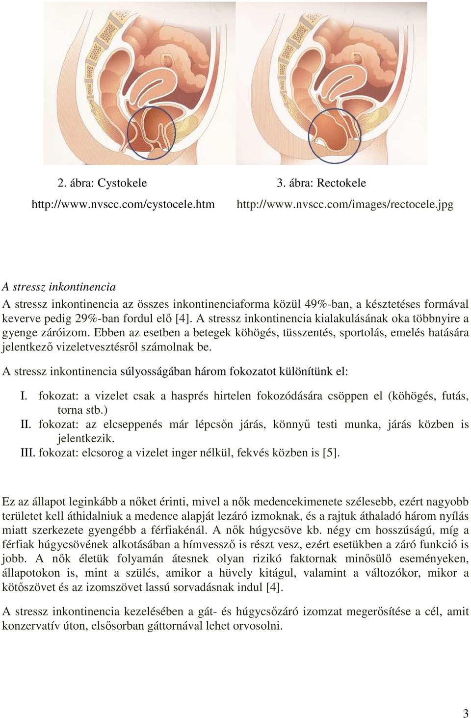 A stressz inkontinencia kialakulásának oka többnyire a gyenge záróizom. Ebben az esetben a betegek köhögés, tüsszentés, sportolás, emelés hatására jelentkező vizeletvesztésről számolnak be.