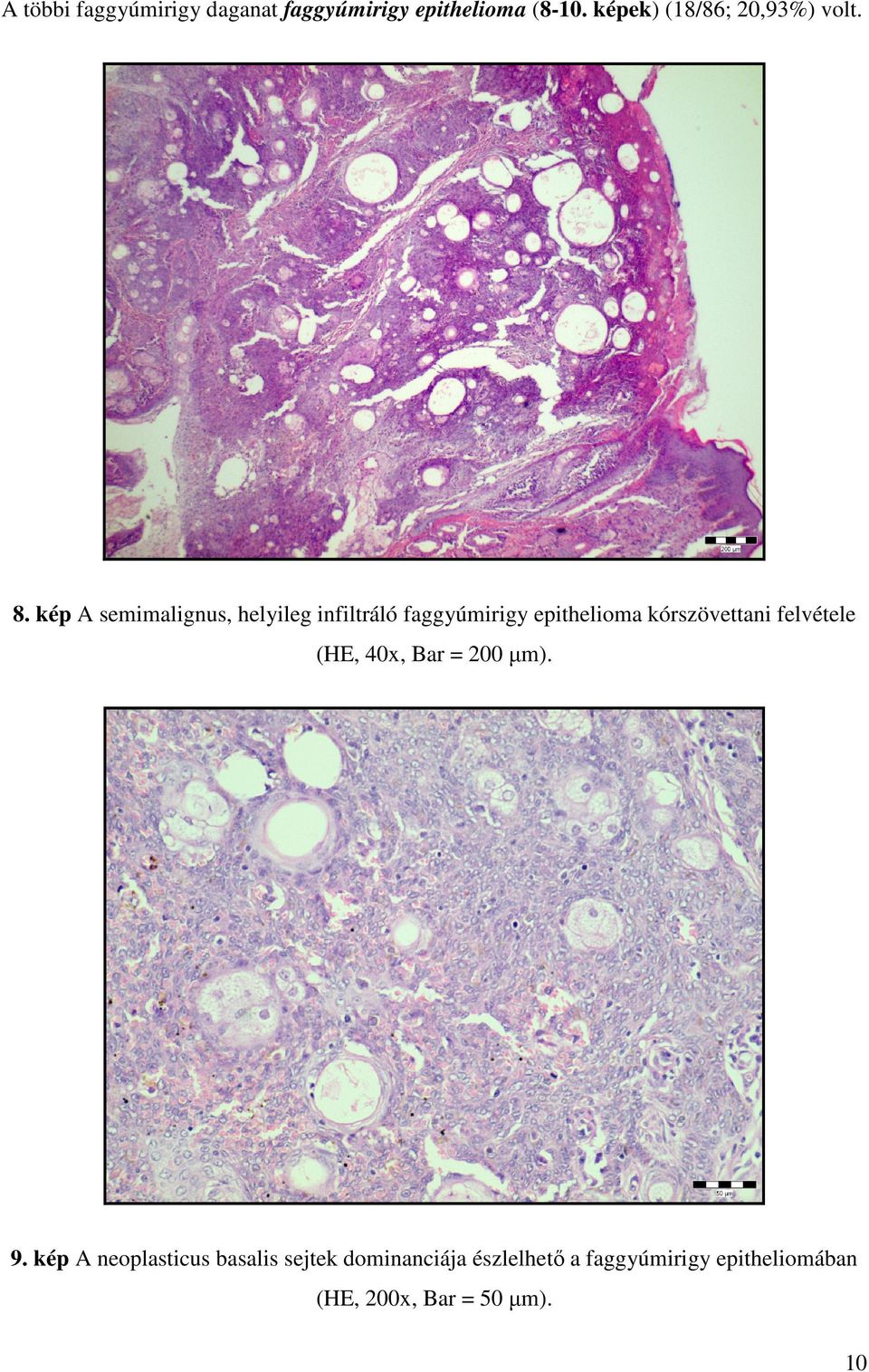 kép A semimalignus, helyileg infiltráló faggyúmirigy epithelioma kórszövettani