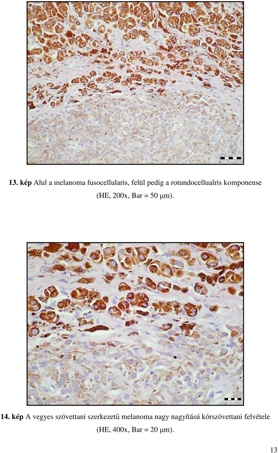 14. kép A vegyes szövettani szerkezetű melanoma nagy