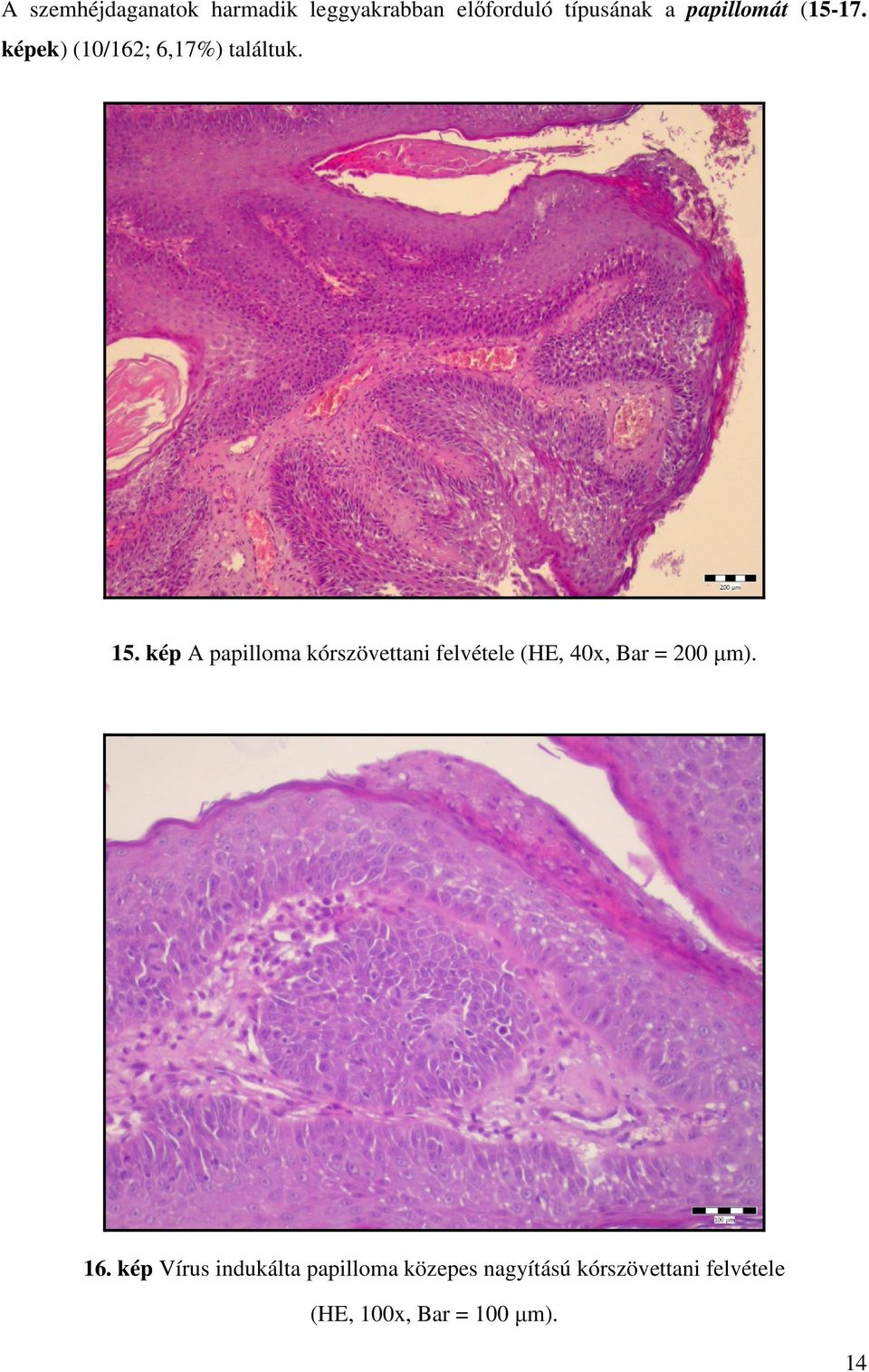 kép A papilloma kórszövettani felvétele (HE, 40x, Bar = 200 µm). 16.