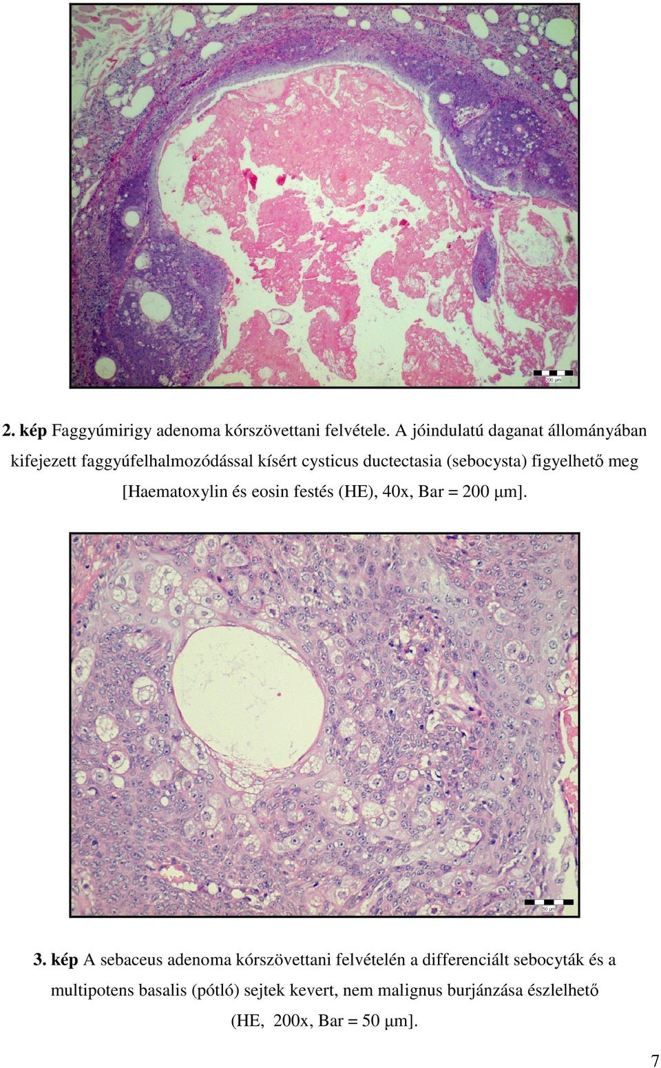 (sebocysta) figyelhető meg [Haematoxylin és eosin festés (HE), 40x, Bar = 200 µm]. 3.