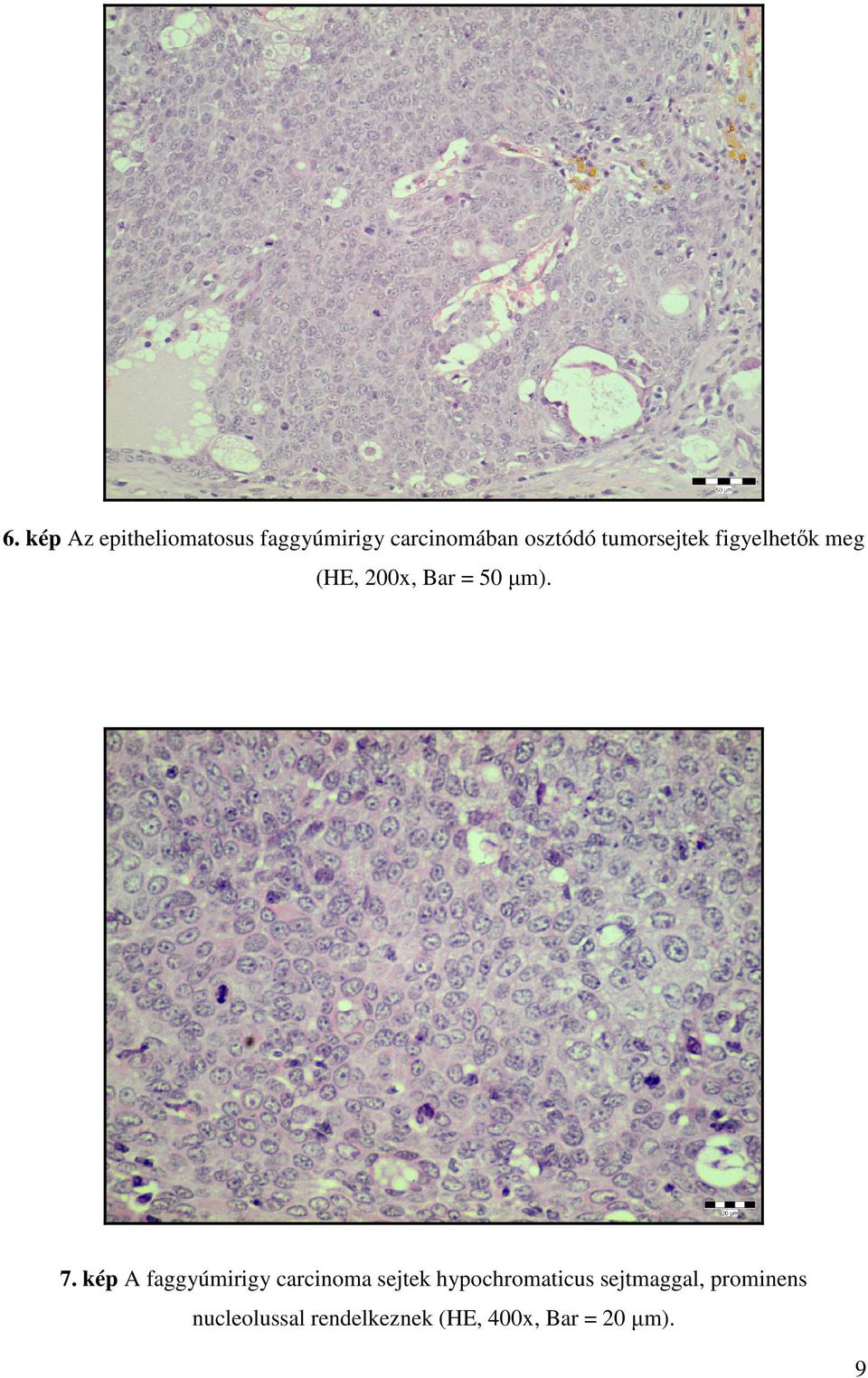 kép A faggyúmirigy carcinoma sejtek hypochromaticus