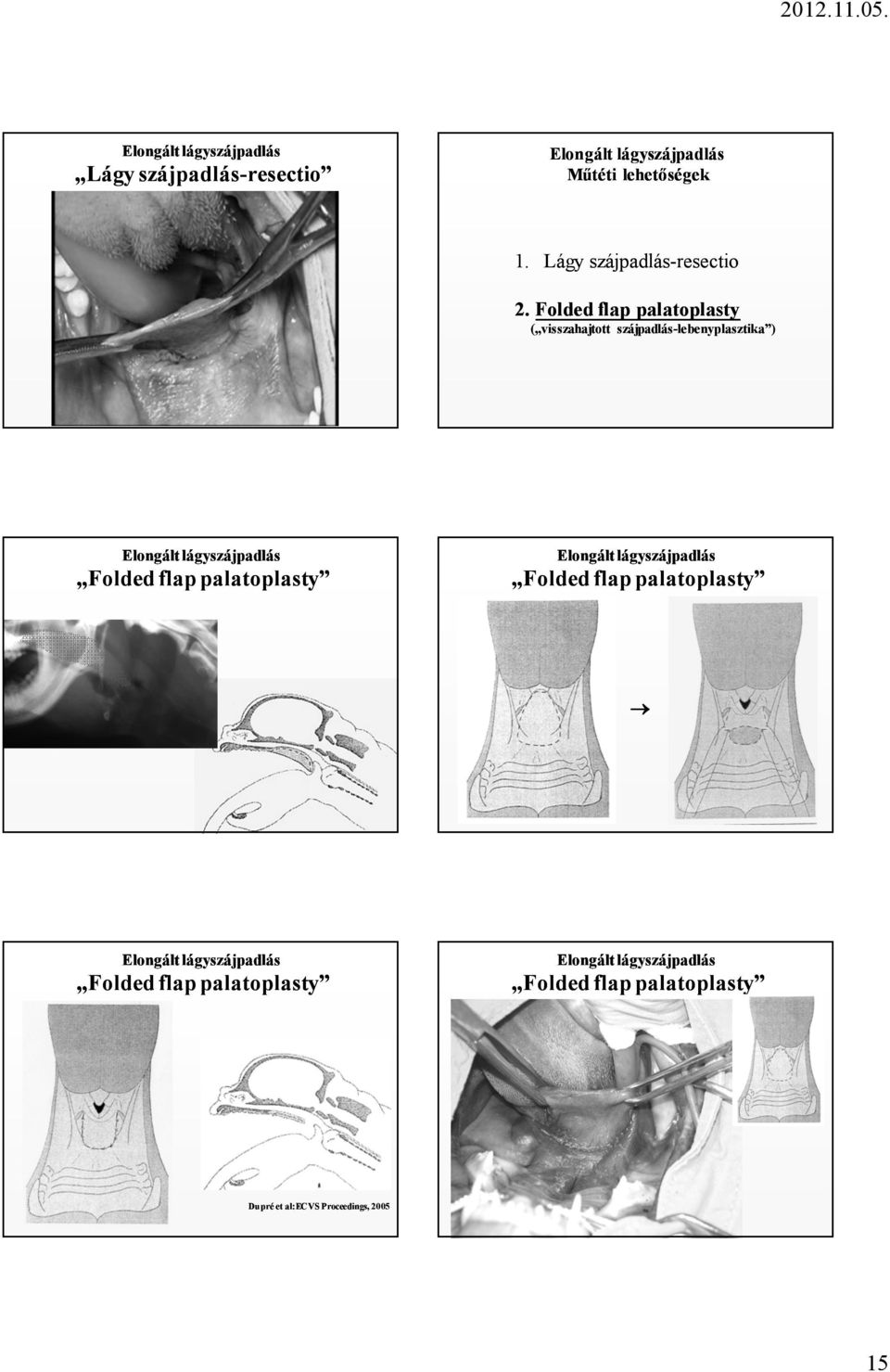 Folded flap palatoplasty ( visszahajtott szájpadlás-lebenyplasztika )