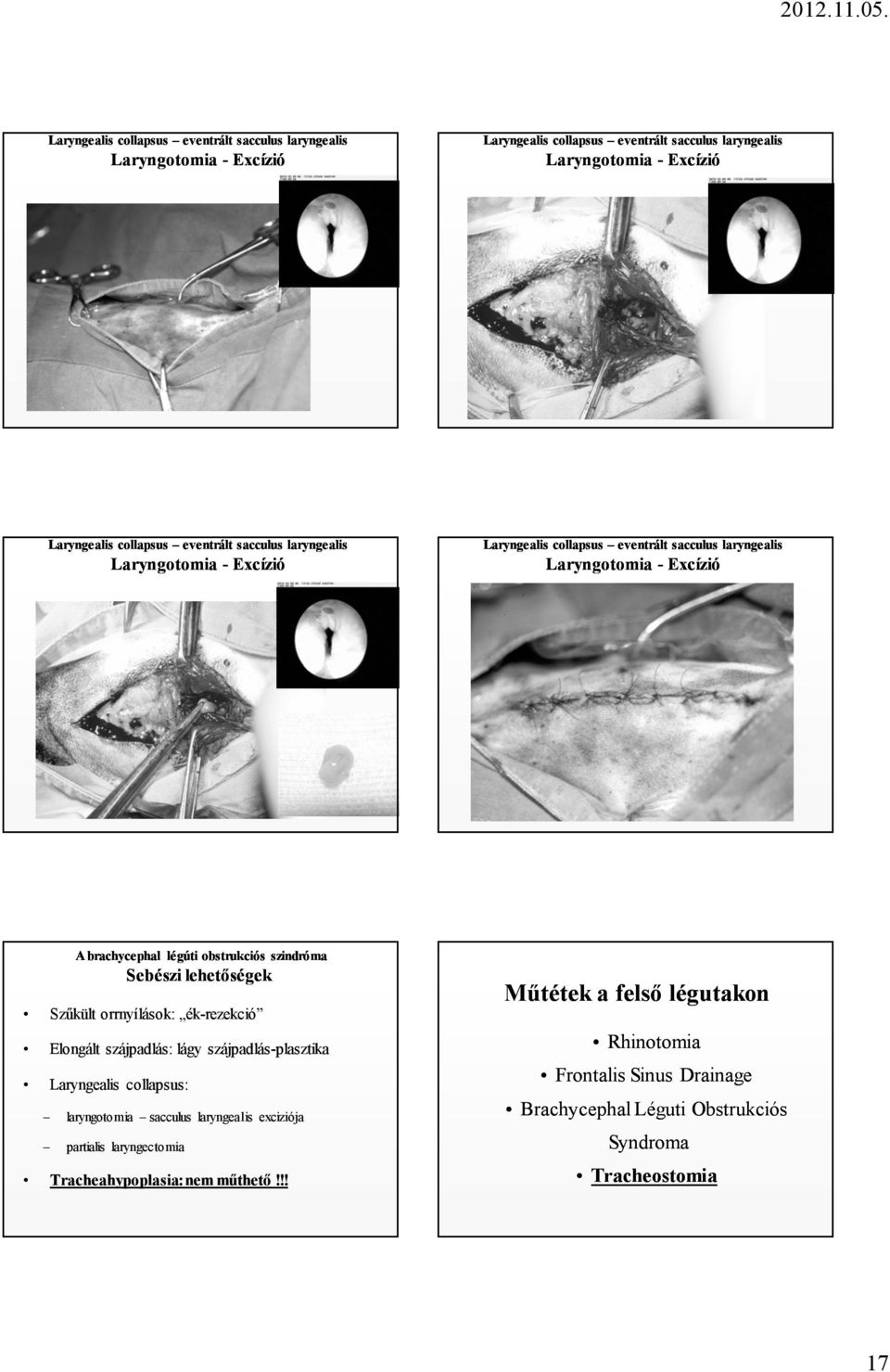 exciziója partialis laryngectomia Tracheahypoplasia: nem műthető!