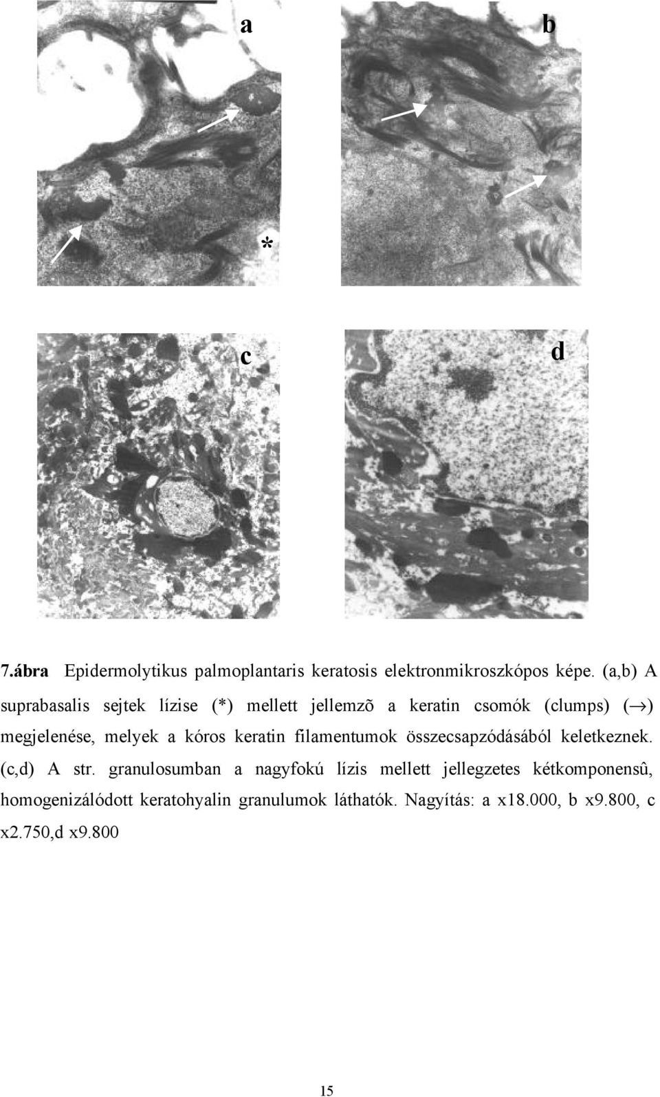 kóros keratin filamentumok összecsapzódásából keletkeznek. (c,d) A str.
